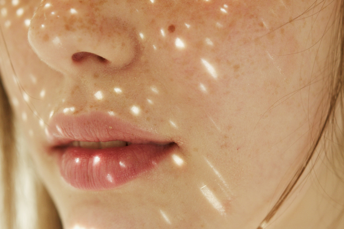 Lippenherpes – wann das Virus ausbricht und wie du ihm vorbeugen kannst